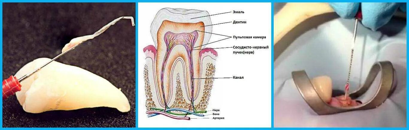 Пульпит витальная экстирпация. Надкостница челюсти анатомия. Пломбирование зуба после лечения каналов