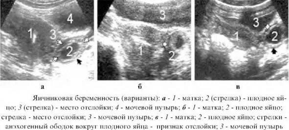 Тянет яичник при беременности на ранних. Яичковая внематочной беременности. Проявление яичниковая беременности. Внесато внематочная беременность. Яичниковая эктопическая беременность.