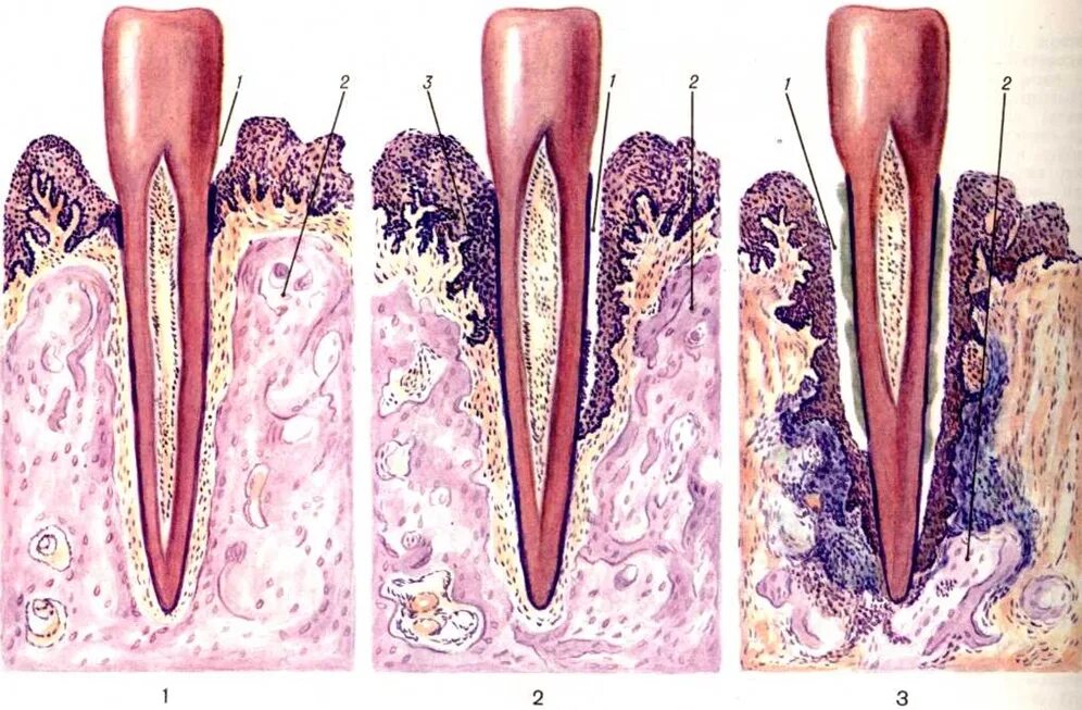 Гангренозный пародонтит. Пародонтит патанатомия. Пародонтоз патологическая анатомия.