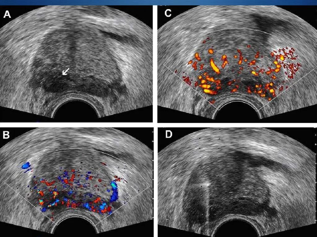 Аденома предстательной железы на УЗИ. Трансректальное УЗИ предстательной железы. Гиперплазия предстательной железы УЗИ. УЗИ трузи предстательной железы. Трузи предстательной железы как делают