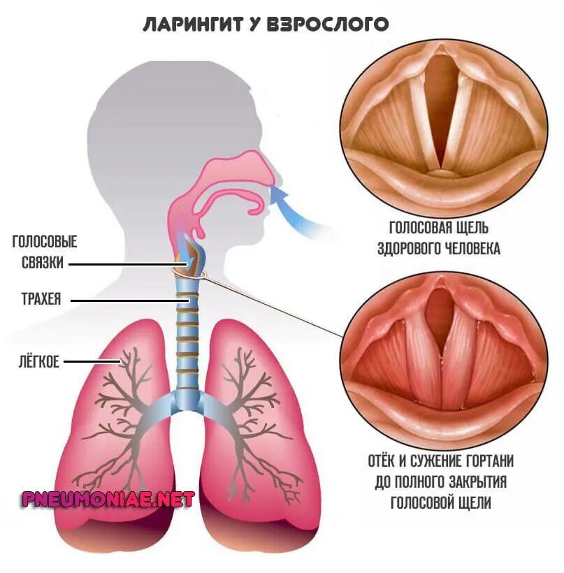 Острый катаральный ларингит. Фарингит ларингит ларингит. Голосовые связки ларингит. Ларингит и фарингит катаральный. Как лечить голосовые