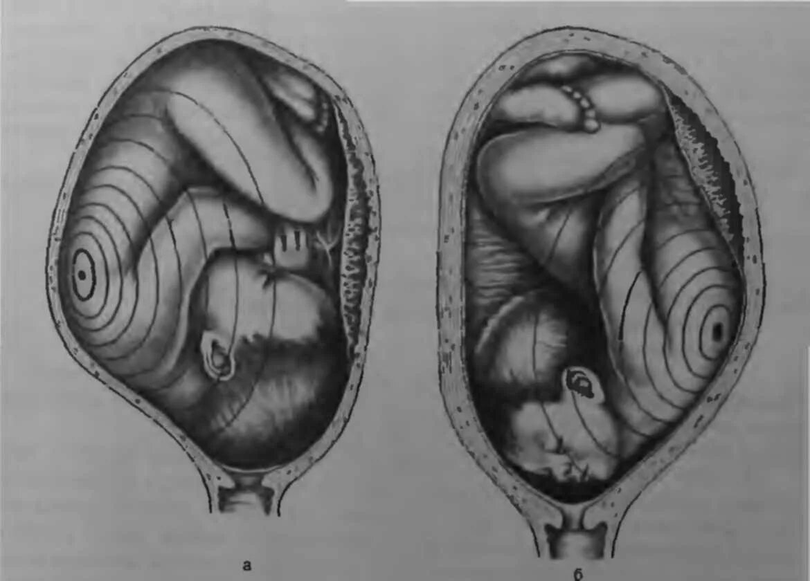 Расположение ребенка в утробе. Положение ребенка в животе. Положение плода в утробе. Расположение ребенка в животе. Ребенок расположен справа