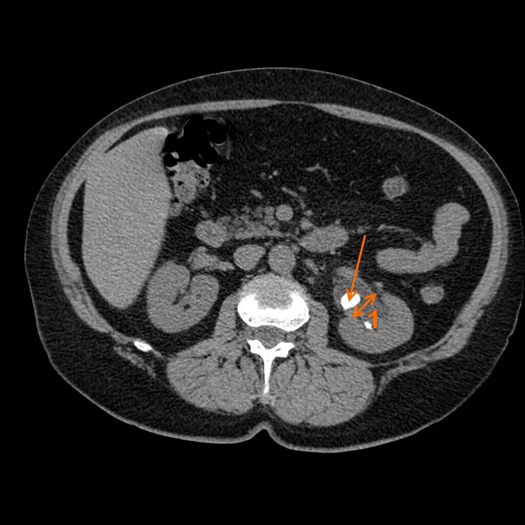Камни на кт видны. Контрастирование почек кт.