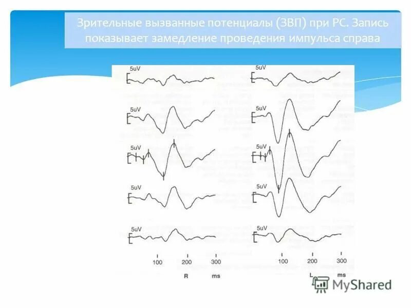 зрительные вызванные потенциалы при рассеянном склерозе. выраженные потенциалы. вызванные потенциалы мозга. выраженные потенциалы. выраженные потенциалы.