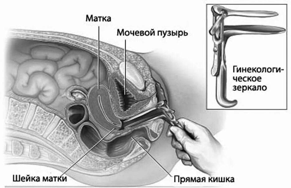 Осмотр в зеркалах алгоритм. Исследование с помощью гинекологических зеркал. исследование шейки матки с помощью зеркал. осмотр шейки матки с помощью зеркала куско. осмотр влагалища и шейки матки в зеркалах.