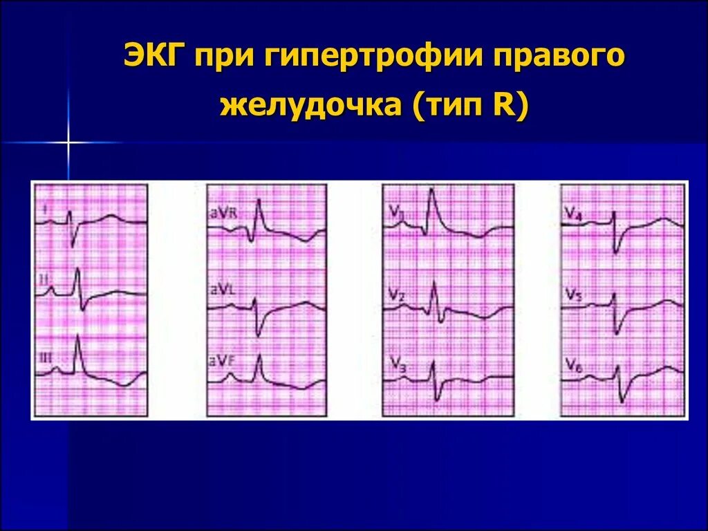 Типы гипертрофии правого желудочка на ЭКГ. S Тип гипертрофии правого желудочка на ЭКГ. Гипертрофия правого желудочка на ЭКГ RSR Тип. ЭКГ при гипертрофии правого желудочка s Тип. Перегрузка на экг что это