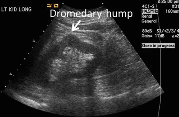 УЗИ почек лекция. Фетальная дольчатость почки на УЗИ. Горбатая почка на УЗИ протокол. Горбатая почка