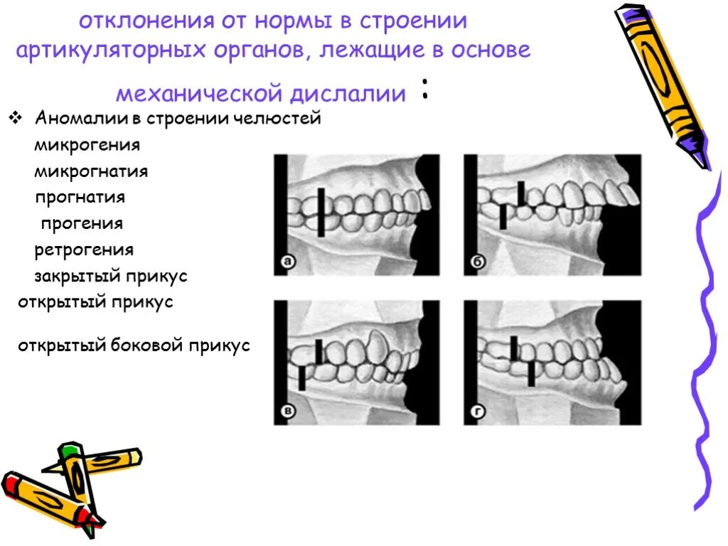 Артикуляторная дислалия. Дефекты механической дислалии. Дефекты строения артикуляционного аппарата. Аномалии в строении артикуляционного аппарата. Формы механической дислалии.