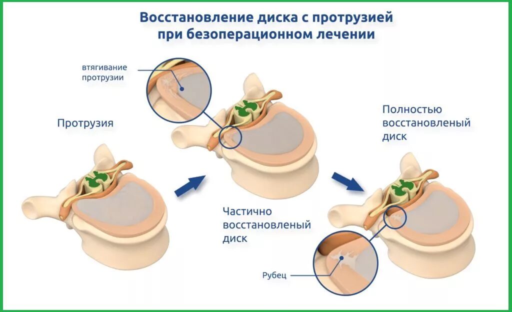 Диффузное выбухание межпозвоночного. Протрузии отдела позвоночника. Протрузия диска позвоночника. Восстановление межпозвонковых дисков. Межпозвонковые диски.