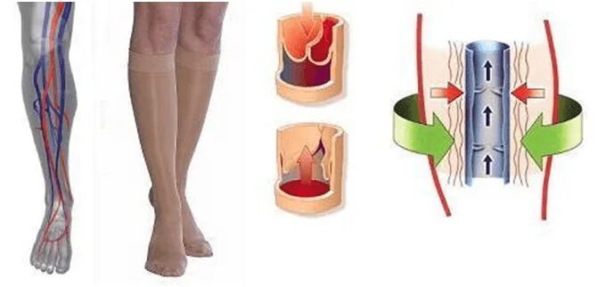 тромбоз глубоких вен клинические рекомендации. компрессионный тромбоз. склеротерапия варикоз. компрессионный тромбоз. варикозное расширение вен компрессионные чулки.
