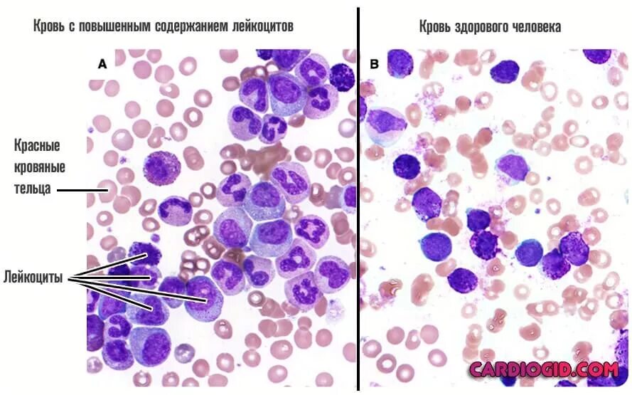 Снижение лейкоцитоза. Лейкоцитоз мазок крови. Мазок крови человека лейкоциты. Лейкоцитоз картина крови. Препарат крови человека лейкоциты.