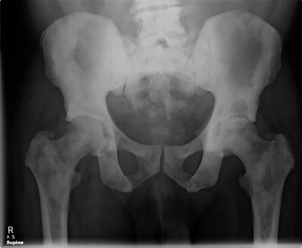 Остеомиелит подвздошной кости. Рентген подвздошной кости. Метастазы костей таза рентген. Подвздошная кость остеомиелит.