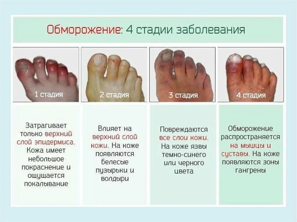 Причины обморожения степени. Отморожение 1 2 степени клинические проявления. Как понять что отморозил пальцы. Отмороженные черные пальцы. При отморожении пальцев рук.