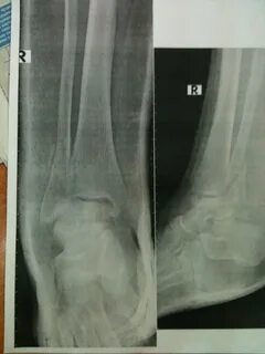 Перелом со смещением лодыжки гипс