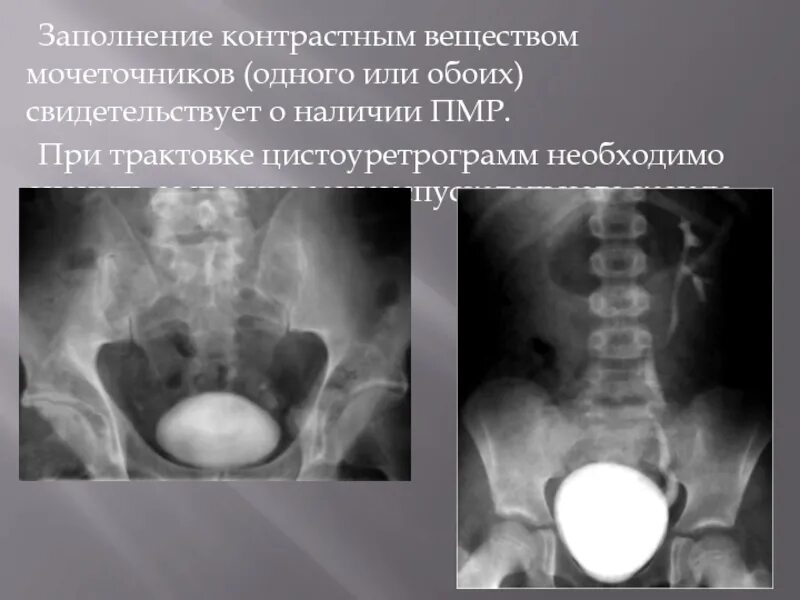 Пузырно-мочеточниковый рефлюкс степени рентген. Сегменты мочеточника рентген. Степень заполнения органа контрастным веществом. Обоих мочеточников