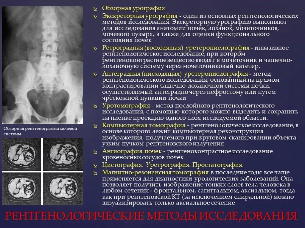 Анализ мочеточника. Рентгенологические методы исследования в урологии. Экскреторная урография методика. Методика проведения внутривенной экскреторной урографии. Экскреторная урография методика проведения.