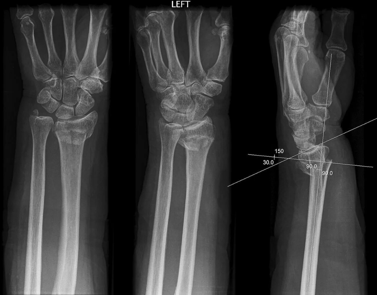 Лучевая трещина. Перелом дистального метаэпифиза лучевой кости левой руки. Перелом лучевой кости рентген. Эпифизеолиз лучевой кости рентген. Рентген оскольчатый перелом лучевой кости.