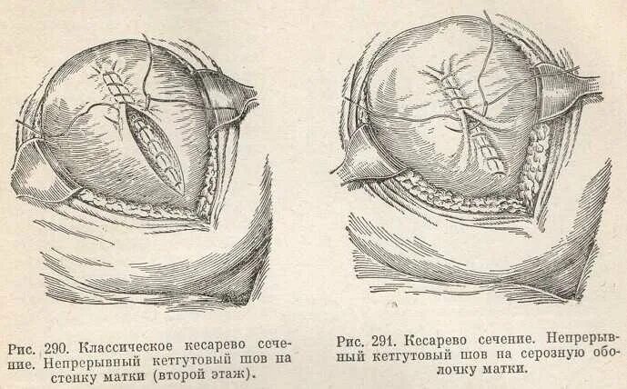 Техника кесарева сечения. Техника операции кесарева сечения. Кесарево сечение ушивание матки. Корпоральное кесарево сечение. Экстраперитонеальное кесарево сечение.