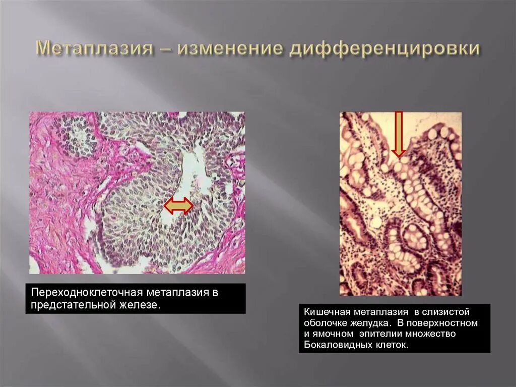 Полная метаплазия желудка. Толстокишечная метаплазия гистология. Кишечная метаплазия желудка гистология. Метаплазия клеток Панета. Метаплазия слизистой оболочки.