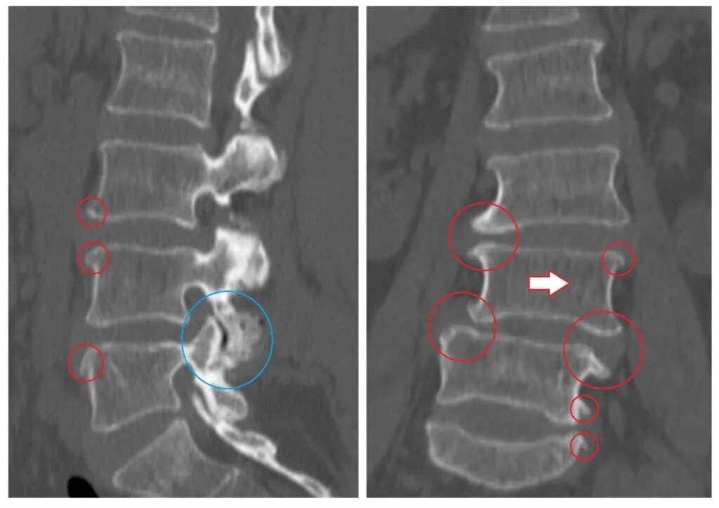 Остеохондроз поясничного отдела l5 s1. Деформирующий спондилез l2 l5. Спондилез l3-l5 что такое. Спондилез и спондилоартроз. Межпозвонковый спондилоартроз сегментов l1-l2 l2-l3 l3-l4 l4-l5.
