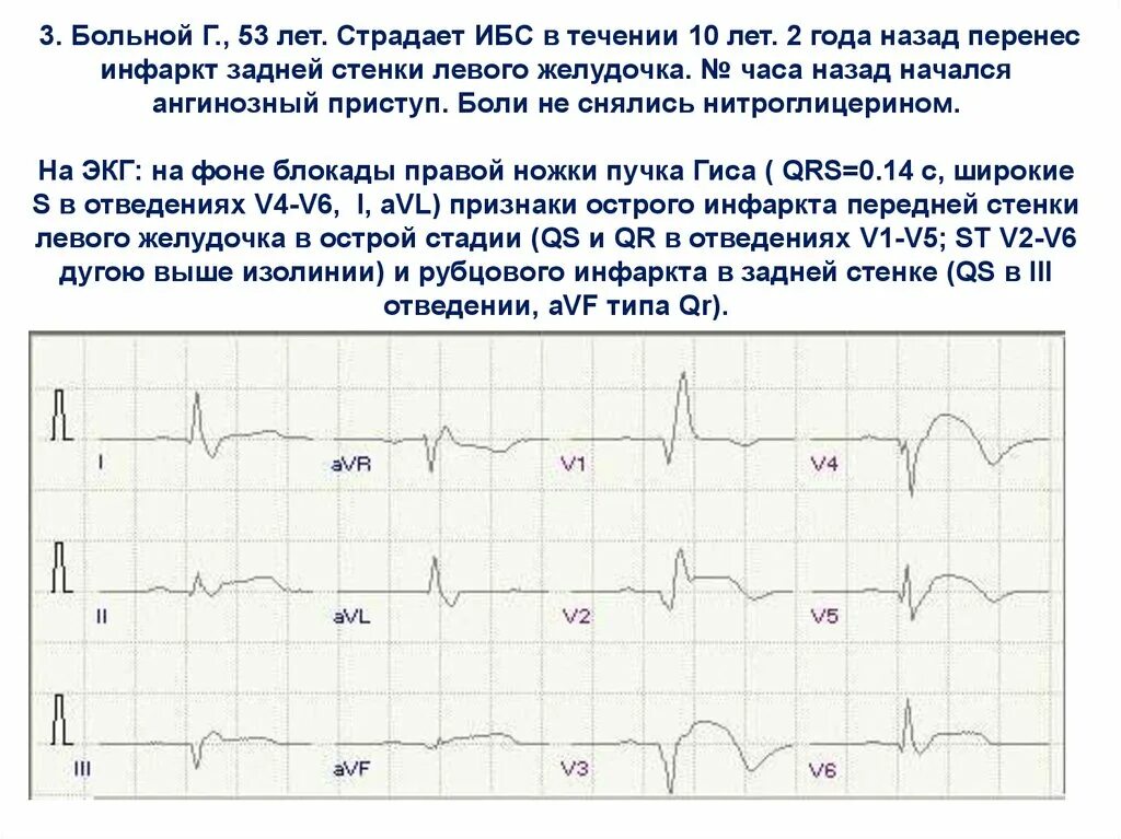 Изменение передней стенки левого желудочка. Инфаркт миокарда левого желудочка ЭКГ. ЭКГ при диффузных изменениях миокарда. ЭКГ критерии инфаркта правого желудочка. Инфаркт миокарда передней перегородки на ЭКГ.