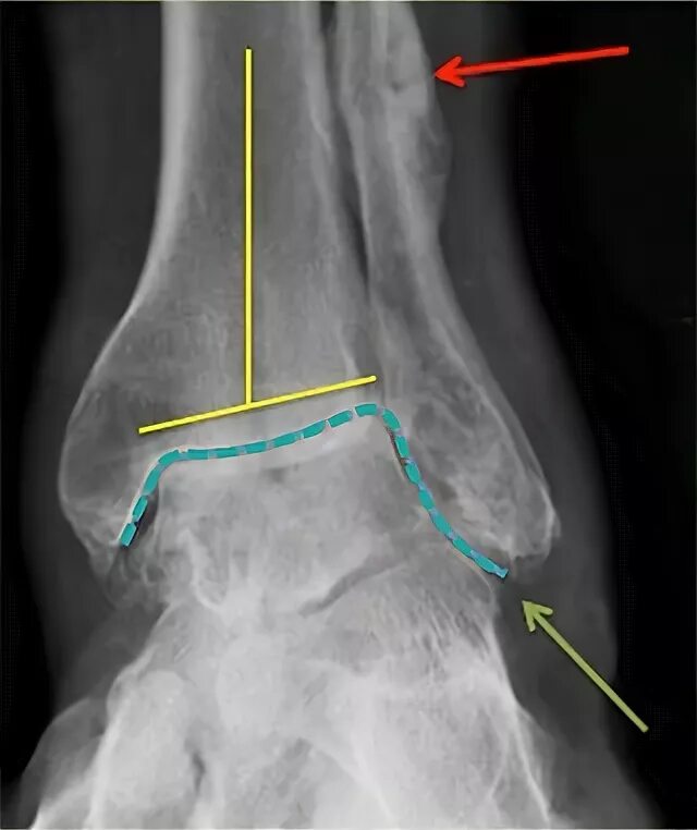 Артроз голеностопного сустава рентген. Доа голеностопного сустава рентген. Остеоартроз голеностопного сустава рентген. Артрит голеностопного сустава рентген.