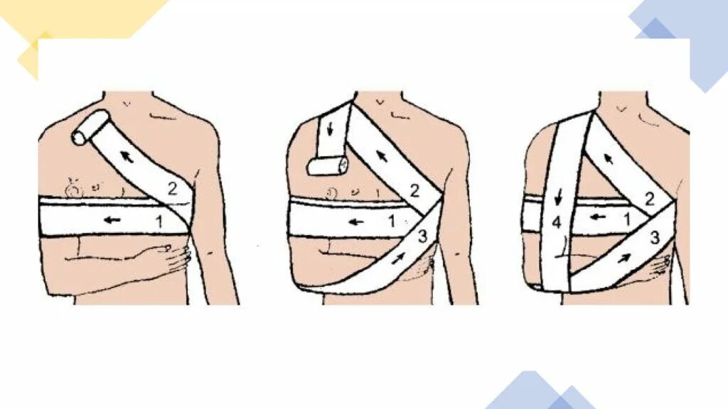 Плечевая повязка алгоритм. Повязка Дезо бинтом техника наложения. Наложение повязки Дезо алгоритм. Повязка Дезо на плечо техника наложения. Повязка Дезо алгоритм.