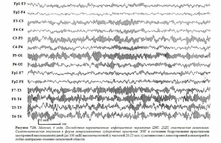 Ээг отзывы детям. Эпилепсия на ЭЭГ. ЭЭГ здорового ребенка. Эпилептиформные феномены на ЭЭГ что это. Генерализованная эпилептиформная активность на ЭЭГ У ребенка.
