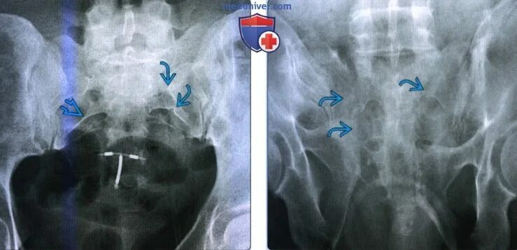 Переломовывих крестца. Поперечный перелом крестца s4. Перелом крестца рентген.