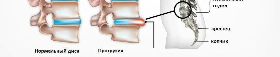 Берут ли с протрузией