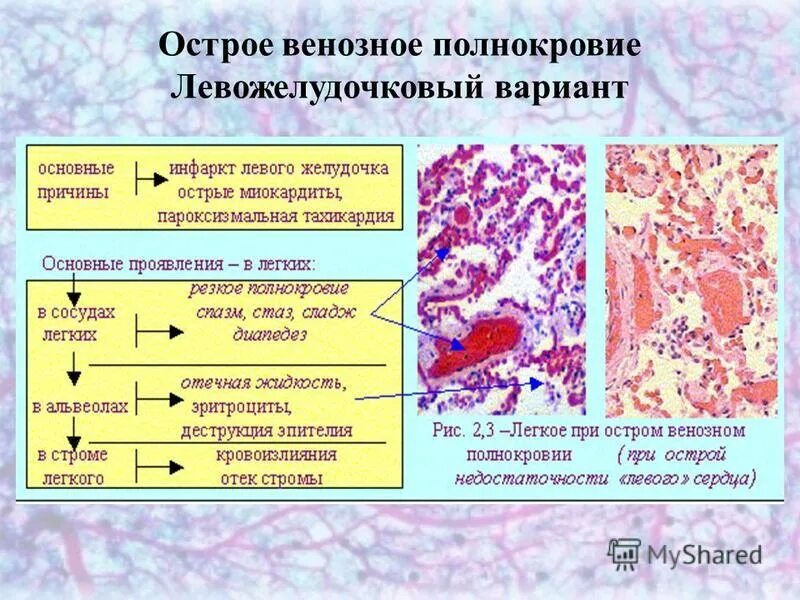 Печень при хроническом венозном застое. При хроническом венозном полнокровии в легких развивается. Острое венозное полнокровие легких. Острая венозная гиперемия.