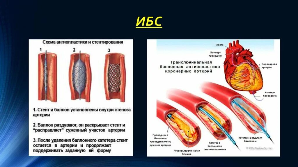 Баллонная коронарная ангиопластика. Баллонная ангиопластика и стентирование. Баллонная ангиопластика при ИБС. ТРАНСЛЮМИНАЛЬНАЯ баллонная ангиопластика и стентирование артерий. Баллонная ангиопластика схема.