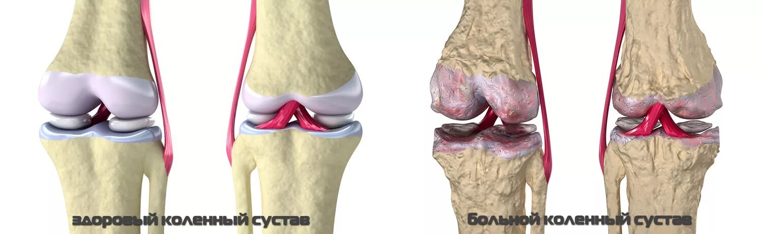 Коленный сустав по стадиям. Деформирующий артрозо артрит. Остеоартрит коленного сустава. Артрозо-артрит коленного. Деформирующий остеоартроз коленного сустава.