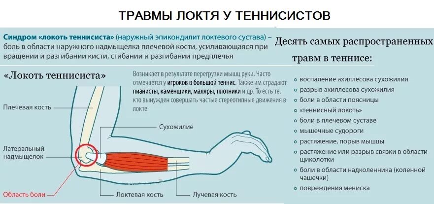 Больно разгибать. Локоть теннисиста латеральный эпикондилит. Латеральный надмыщелок плечевой кости болит. Латеральный эпикондилит локтевого сустава симптомы. Травма локтевого сустава эпикондилит.