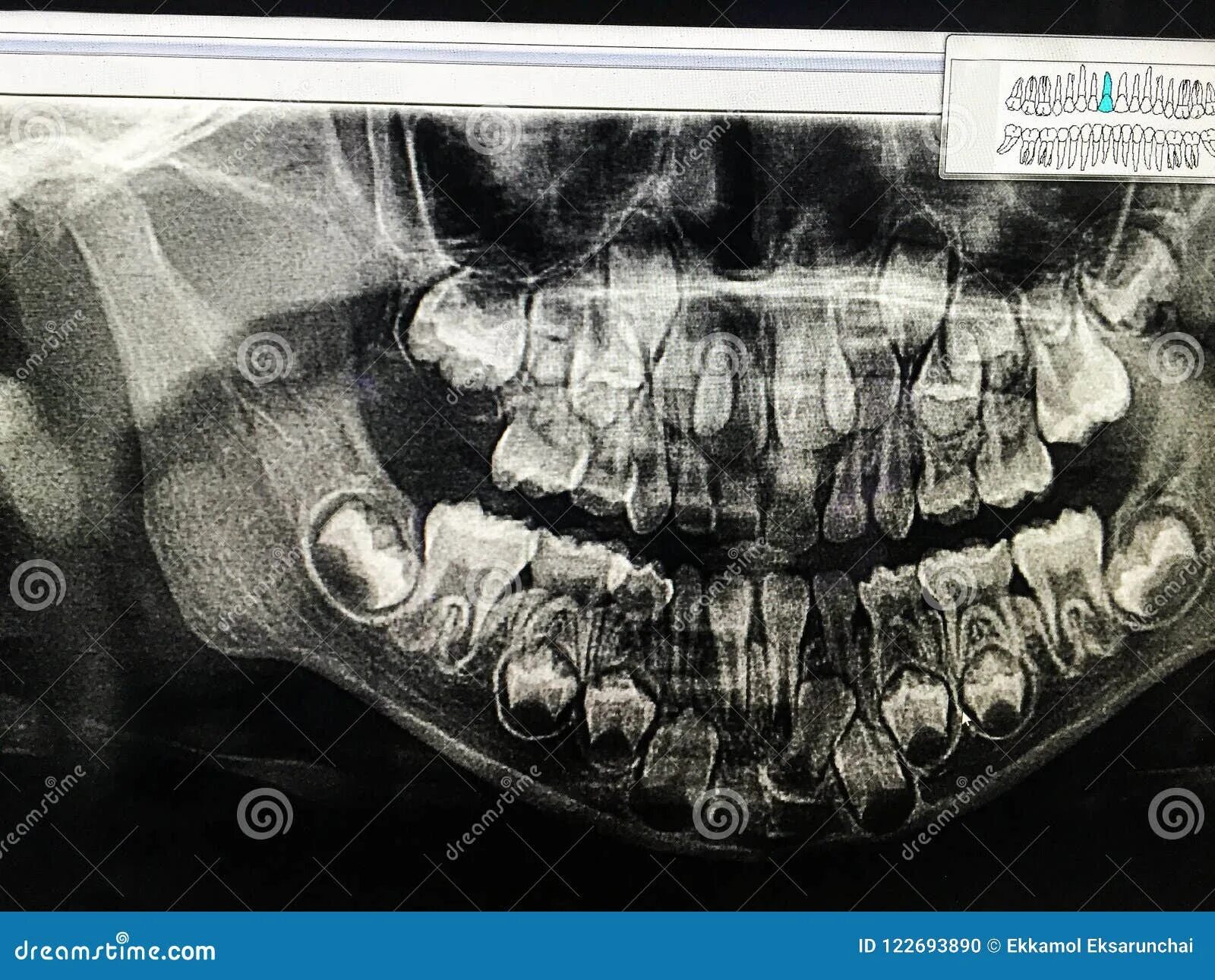 Рентген челюсти младенца. Рентгеновский снимок зубов ребенка. Рентгеновский снимок детской челюсти.