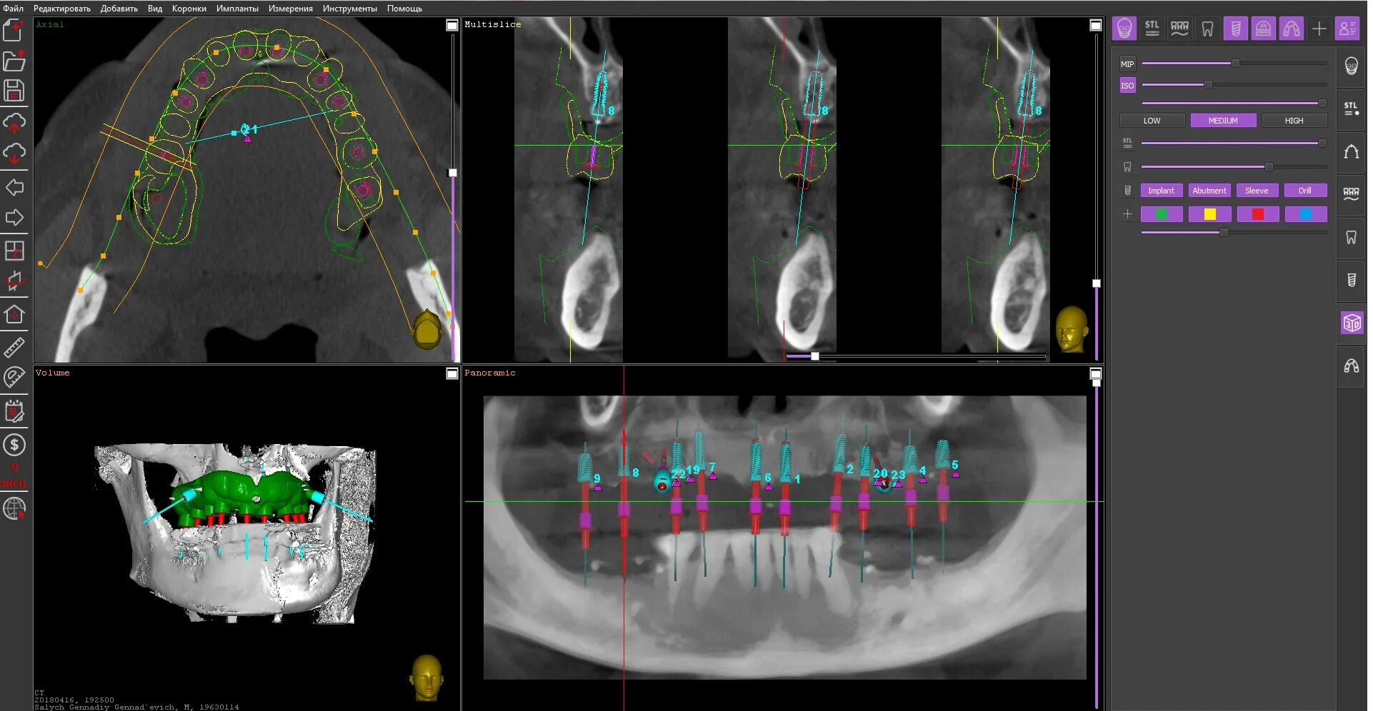 Программа имплантации. Хирургический шаблон для имплантации. Программа имплантации. Моделирование хирургических шаблонов. Программа имплантации.