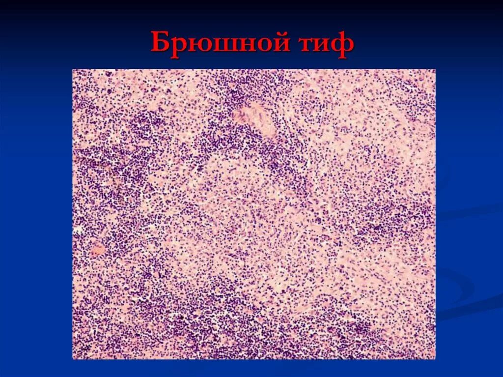 Сифилитическая гранулема гумма печени. Классификация кишечных инфекций патанатомия. Микобактериальные инфекции. Некроз пейеровых бляшек при брюшном тифе микропрепарат. Кишечные инфекции патанатомия.