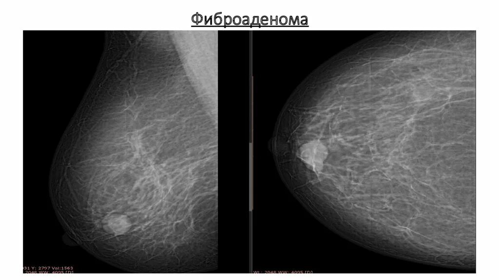 Фиброаденома молочной железы маммограмма. Фиброаденома молочной железы маммография. Маммография фиброаденома снимок. Маммография фиброаденома.