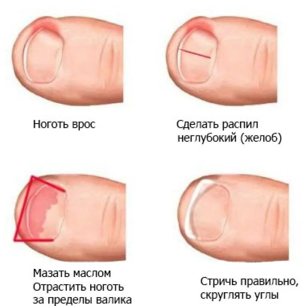 Вросший ноготь на большом пальце. Вросший ноготь поздняя стадия. Обработка вросшего ногтя схема. Срошийвся ноготь на ноге. Вырастает ноготь что делать