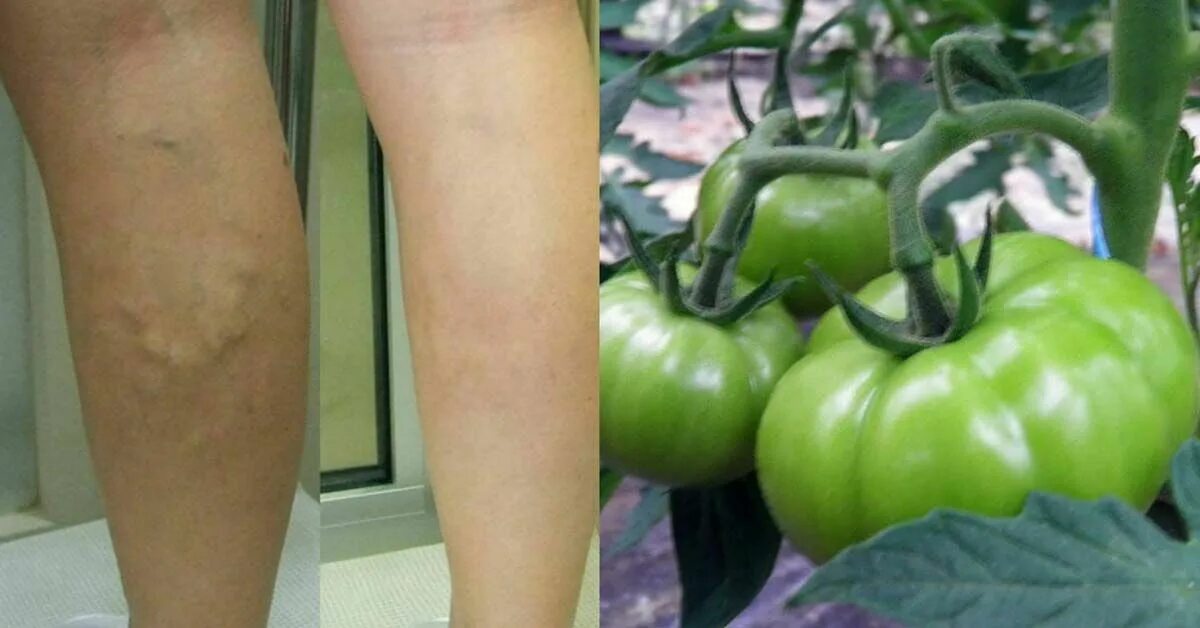 Зеленые помидоры от варикоза. Зеленые помидоры от варикоза на ногах. Народные средства от варикоза. Варикоз лечение народными средствами в домашних условиях