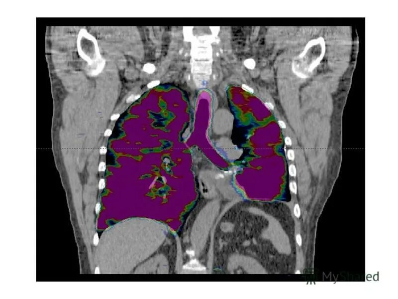 Кт мрт томограммы легких. Кт грудной клетки онкология.