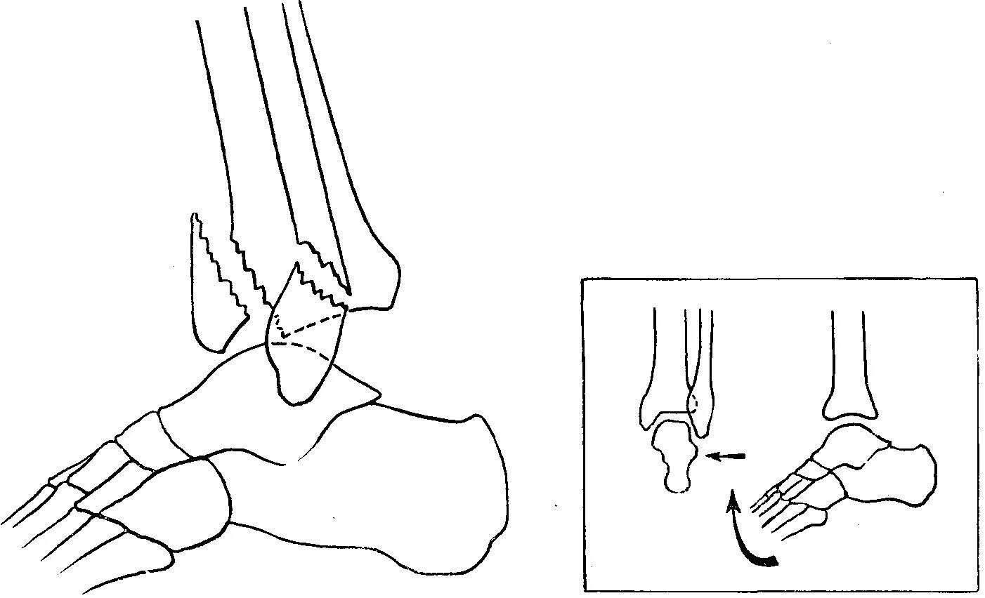 Как разработать стопу после перелома. Лечебная физкультуры при переломе берцовой кости. Лечебная гимнастика при переломе берцовой кости. Реабилитационные упражнения после перелома лодыжки. Лечебная гимнастика для голеностопа после перелома.
