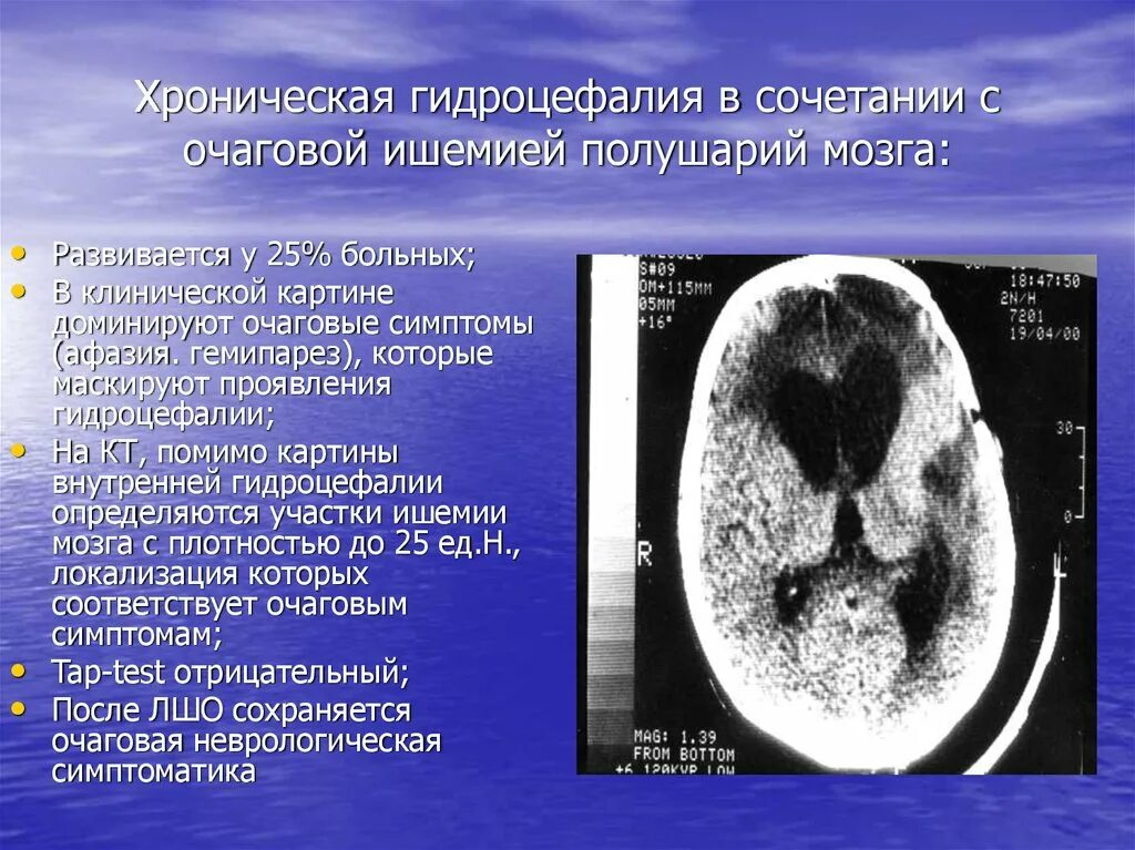 Ишемическое повреждение головного мозга. Хроническая ишемия мозга на кт. Хроническая ишемия головного мозга на кт. Ишемическая гидроцефалия. Причины ишемии мозга