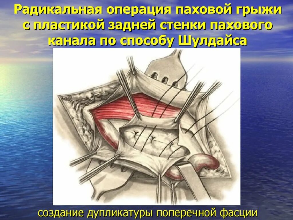 Стенки канала паховой грыжи. Задняя стенка пахового канала. Схемы пластики пахового канала при прямых и косых паховых грыжах. Лихтенштейн операция грыжа