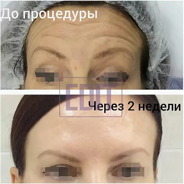 Как вывести ботокс из лба побыстрее. Лифтинг бровей ботоксом схема. ботокс под бровь точка. куда колят ботокс чтобы поднять брови фото. разметка как поднять брови ботоксом.