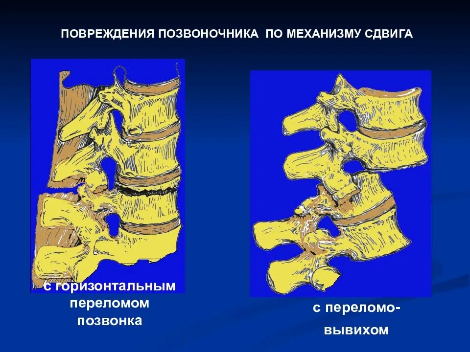 Повреждение позвонков. Сгибательно-вращательный механизм повреждения позвоночника. переломовывих позвонка. сгибательный механизм травмы позвоночника. переломовывихи позвонков.