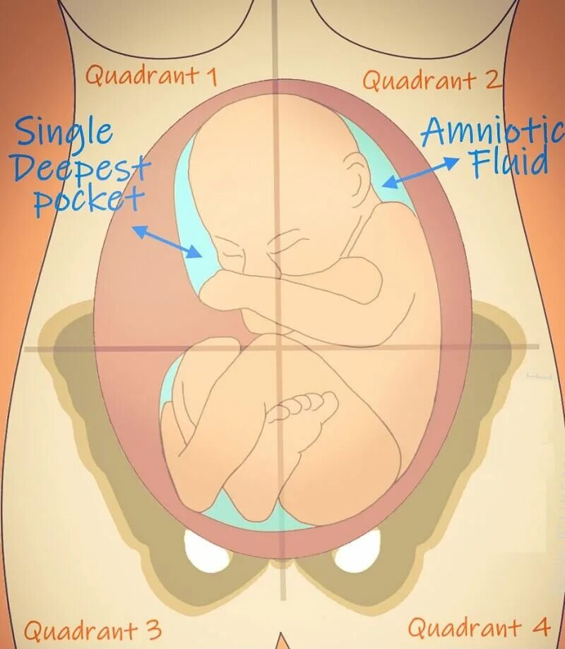Количество околоплодных вод по неделям. Карман амниотической жидкости. Максимальный карман околоплодных вод. Измерение амниотической жидкости. Вертикальный карман околоплодных вод.