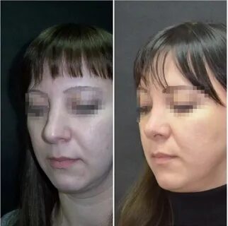 Ринопластика пластические хирурги