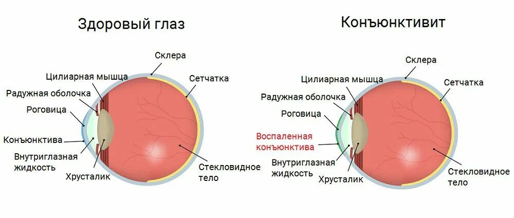 Посттравматический конъюнктивит мкб. Аллергический конъюнктивит мкб.