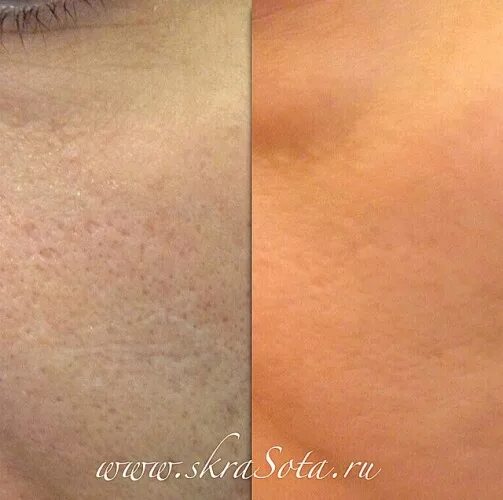 шлифовка расширенных пор. лазерная шлифовка сужает поры. шлифовка расширенных пор. мезотерапия рубцов постакне. лазерная шлифовка расширенных пор.